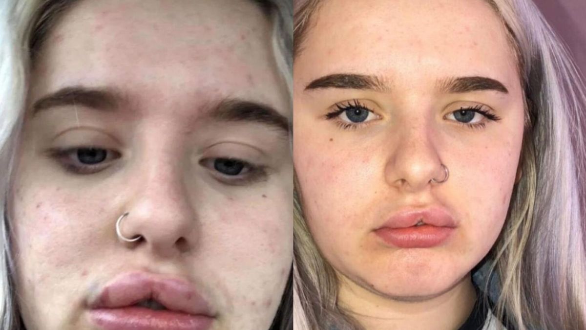 17-latka wstrzyknęła w usta wypełniacz. "Nienawidziłam swojej twarzy"