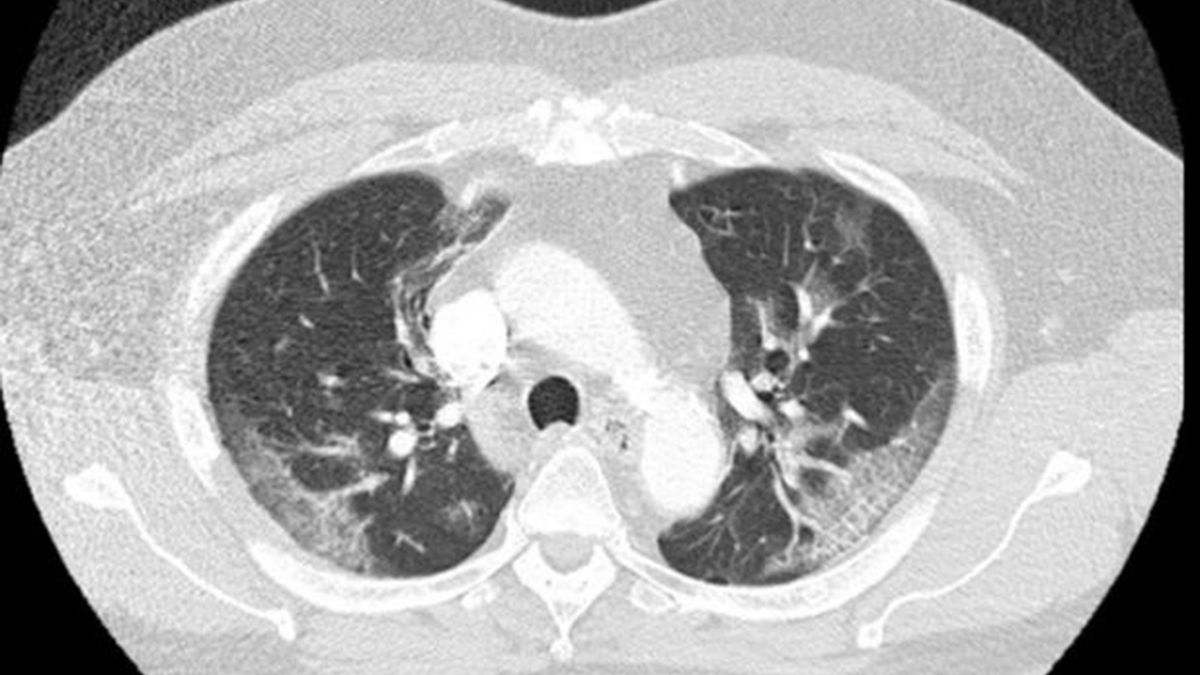 Płuca pacjenta zarażonego koronawirusem