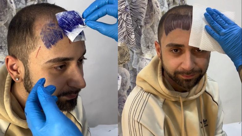 Mężczyzna wytatuował sobie grzywkę, by ukryć łysinę