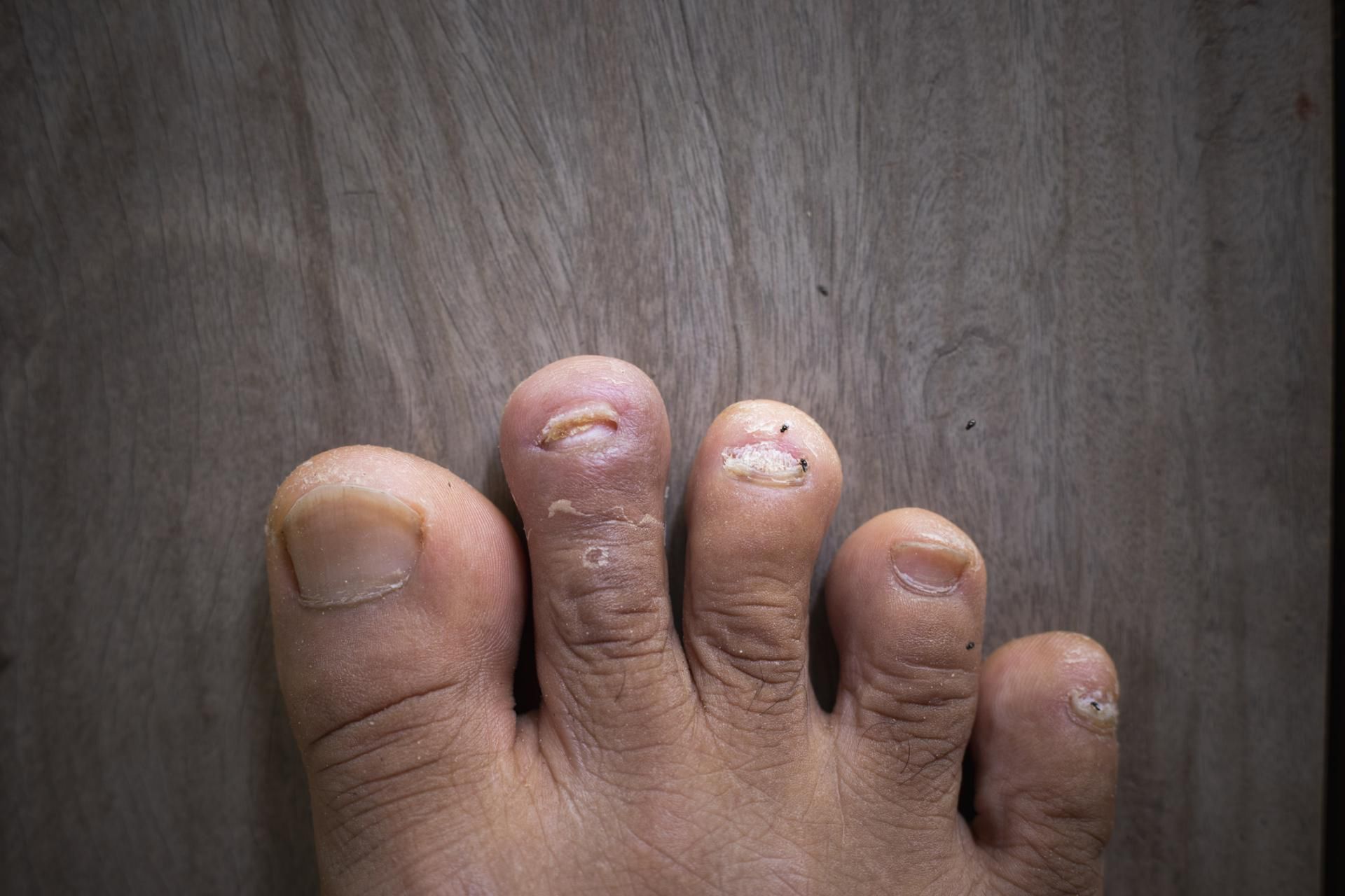 Objaw wysokiego cholesterolu można zauważyć na paznokciach