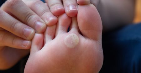 Chcesz usunąć odciski? Sięgnij po kolorową przyprawę z kuchennej szafki
