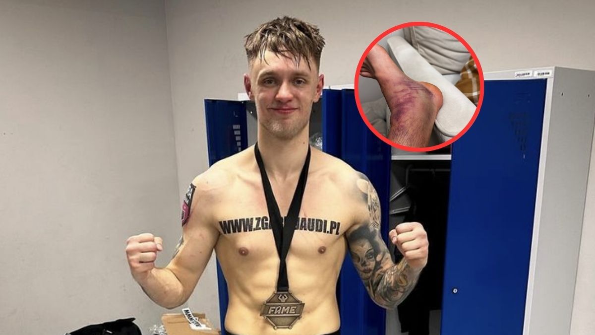  / Dawid Malczyński pokazał jak wygląda po walce