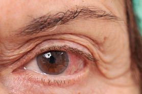 Oko - wady wzroku, higiena, dieta. Choroby oczu jako skutek cukrzycy, nadciśnienia czy alergii