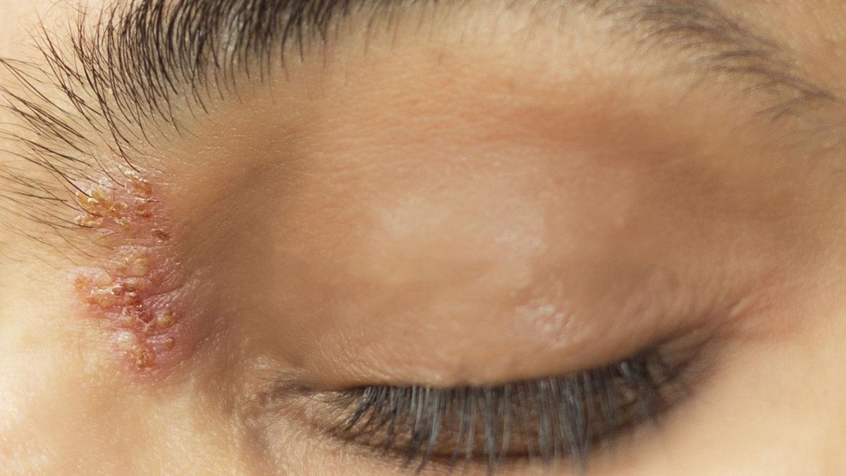 Półpasiec oczny objawia się najpierw wysypką na powiece.