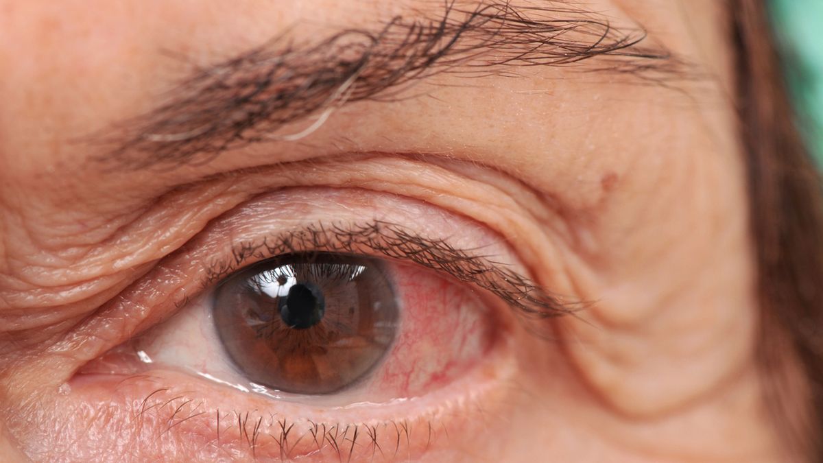 Choroby oczu mogą wystąpić w takich schorzeniach, jak: cukrzyca, nadciśnienie tętnicze, choroby alergiczne, choroby tarczycy.