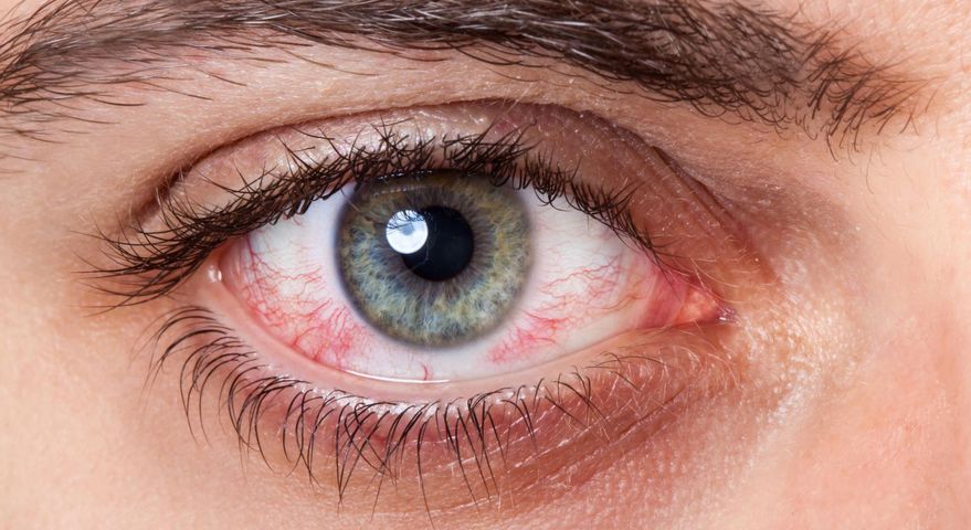 Zapalenie spojówek a alergia – jak rozróżnić? Porady eksperta