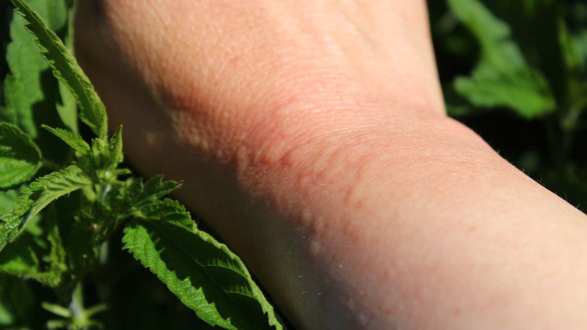 Poparzenie pokrzywą może skończyć się nawet wstrząsem anafilaktycznym