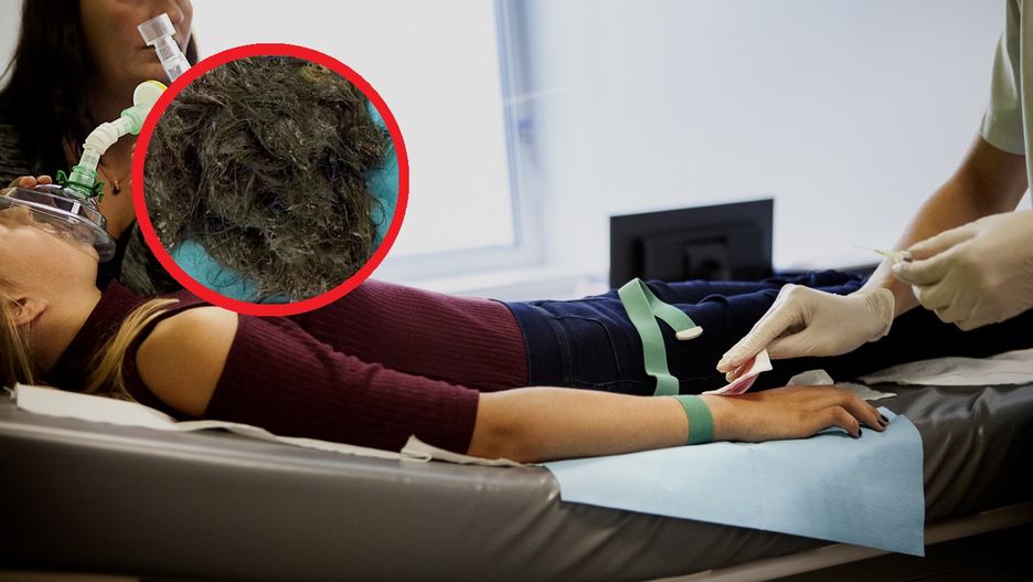 14-latka przestała jeść i pić. Lekarze znaleźli w jej żołądku 3 kg włosów