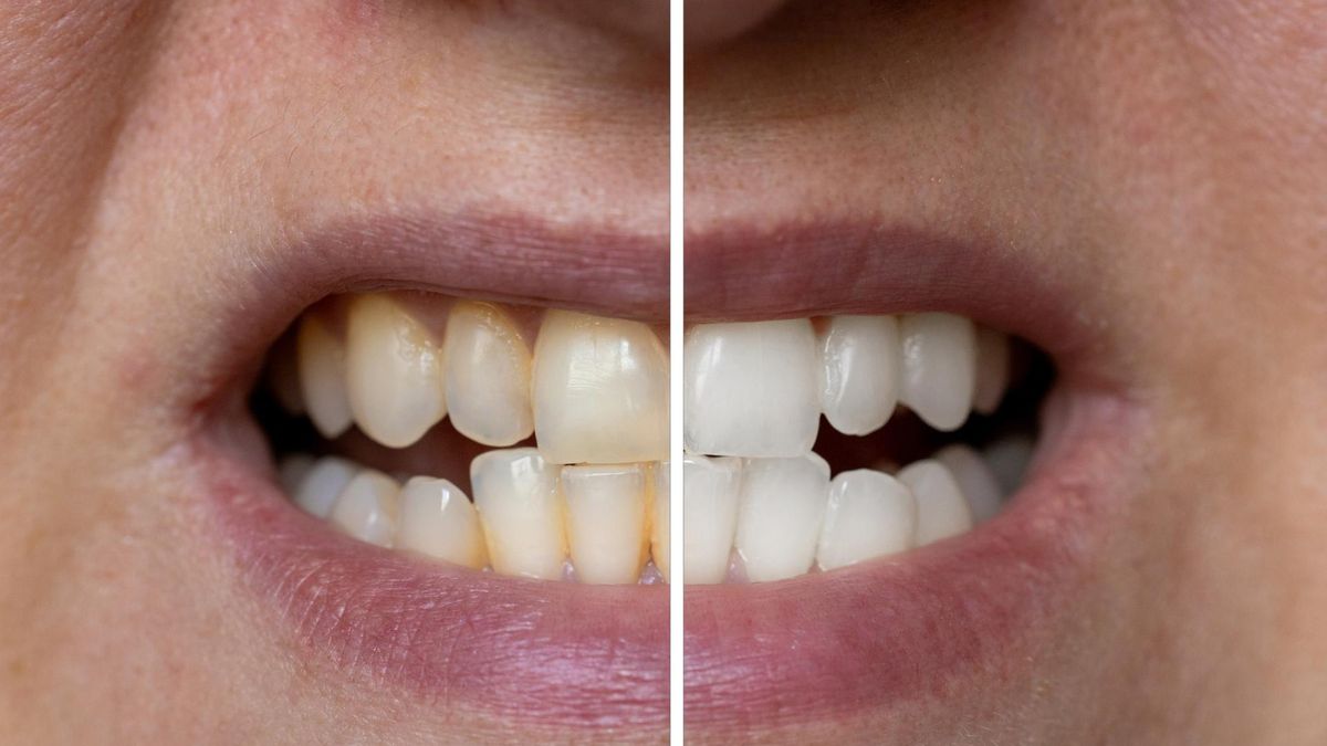 Jak skutecznie i bezpiecznie wybielić zęby?