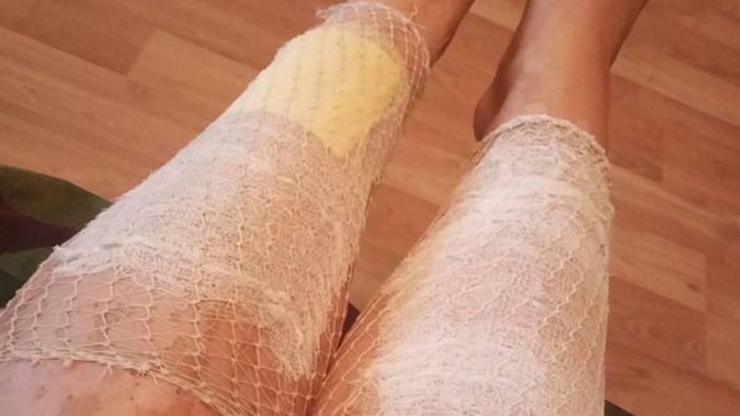 Zabieg IPL poparzył Anastasii skórę na nogach