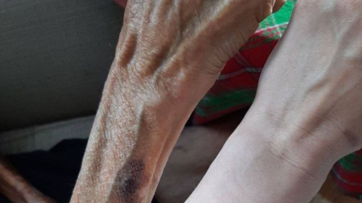 Ukrainka pokazała wychudzoną rękę wujka, który uciekł z Mariupola