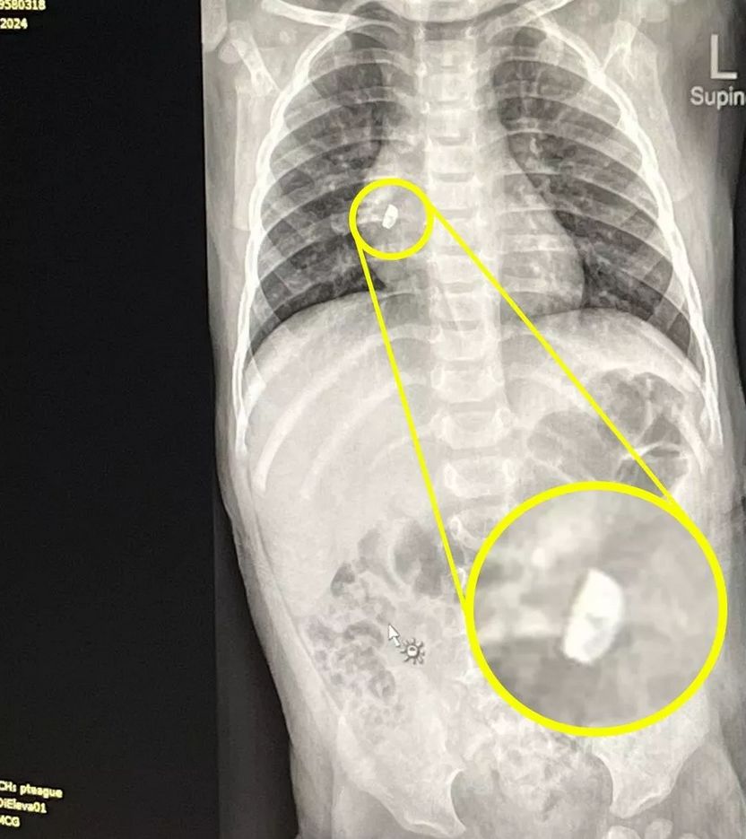 Rodzice nie sądzili, że kolczyk doprowadzi do tak poważnej sytuacji