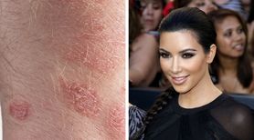 Stres zaostrzył u Kim Kardashian objawy łuszczycy 
