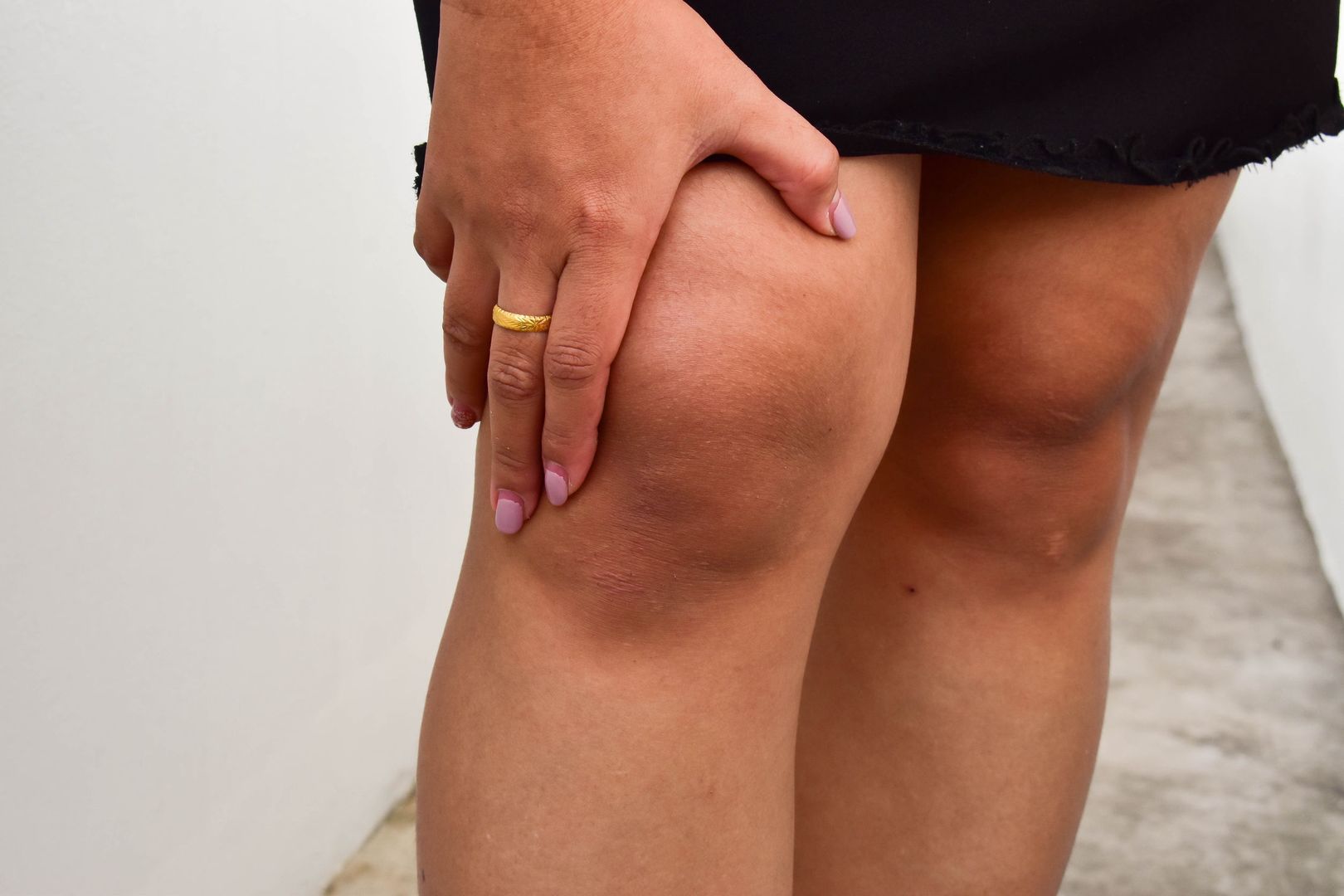 Opuchlizna kolan może wskazywać na zakrzepicę 