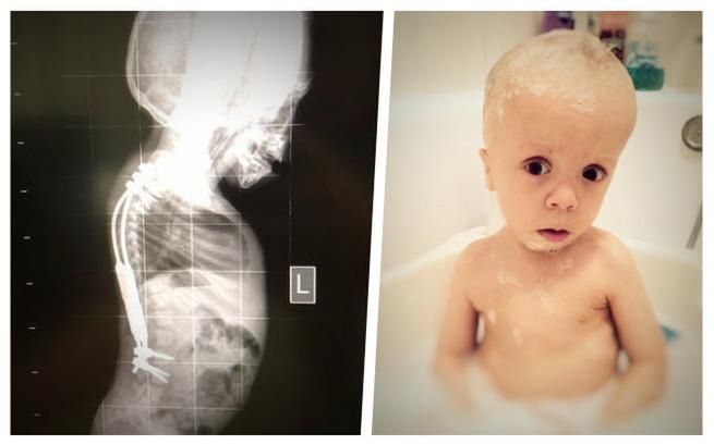 Lekarze początkowo podejrzewali, że chłopiec cierpi na wrodzoną łamliwość kości.