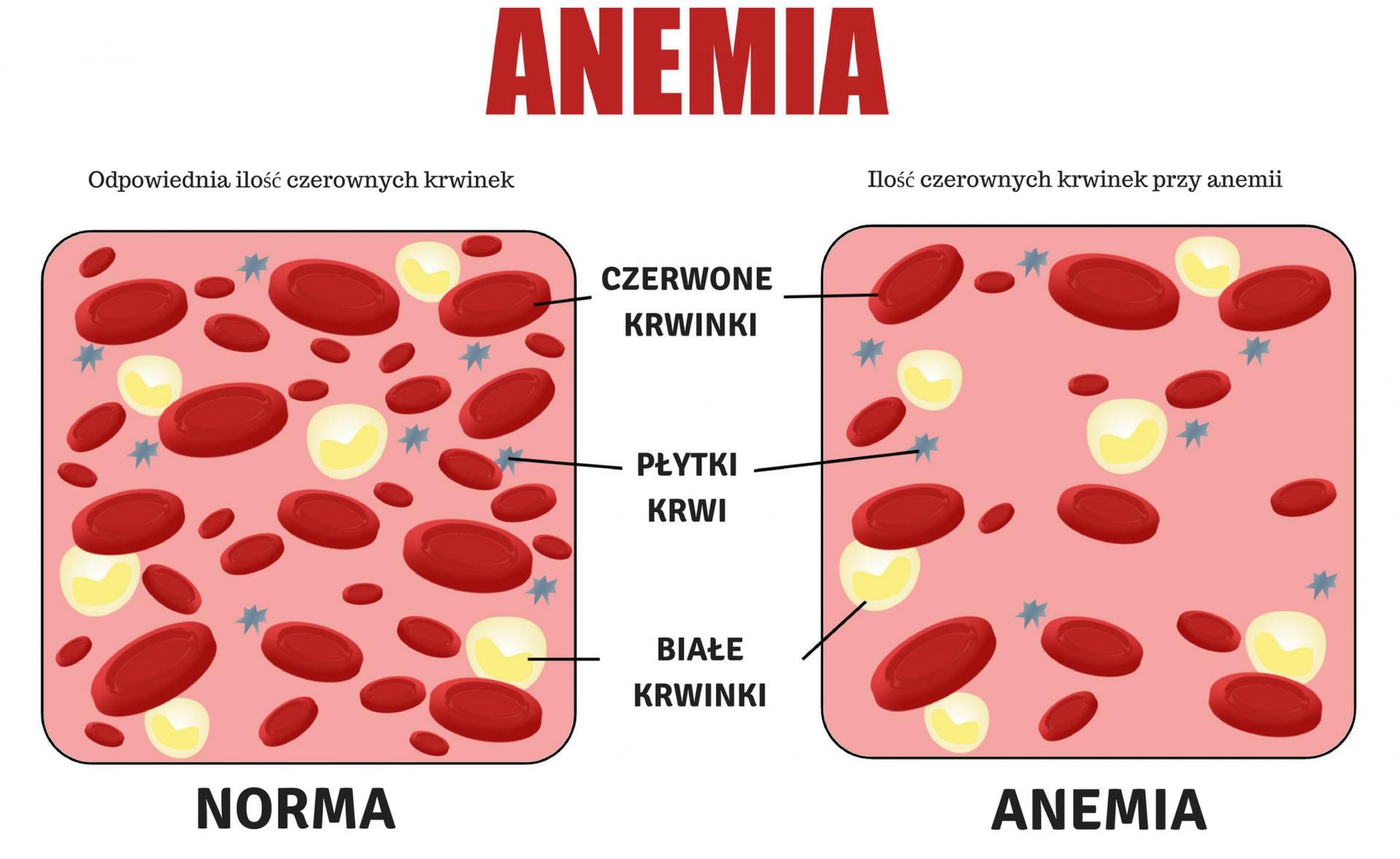 Anemia i nowotwór