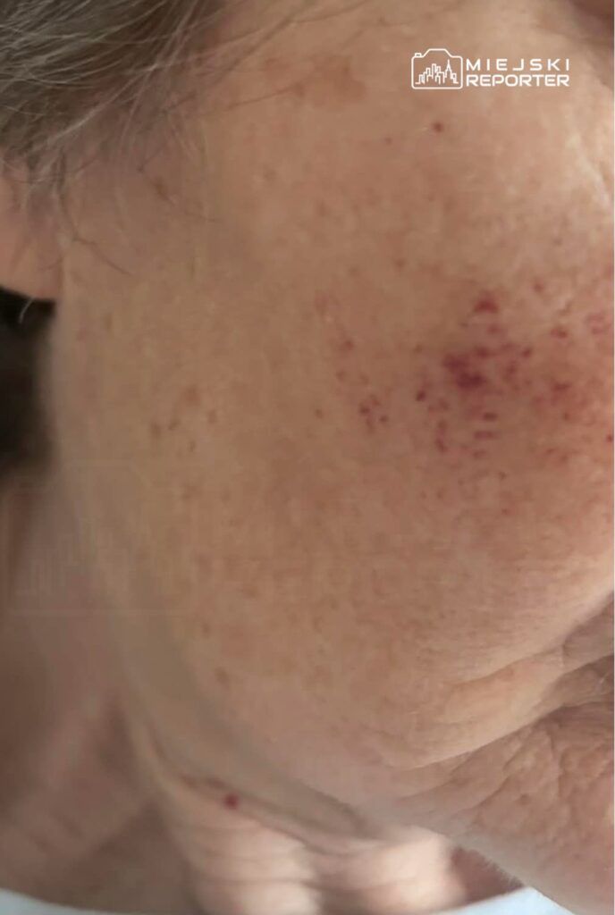 Zbliżenie na policzek starszej osoby z widocznymi czerwonymi plamkami i zmarszczkami.