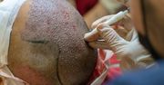 Polacy do Turcji latają po słońce. Niemcy i Rosjanie po... przeszczep włosów
