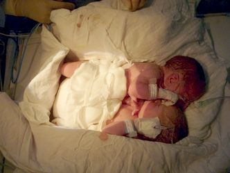 Syjamskie bliźniaki rozdzielone. Operacja się udała