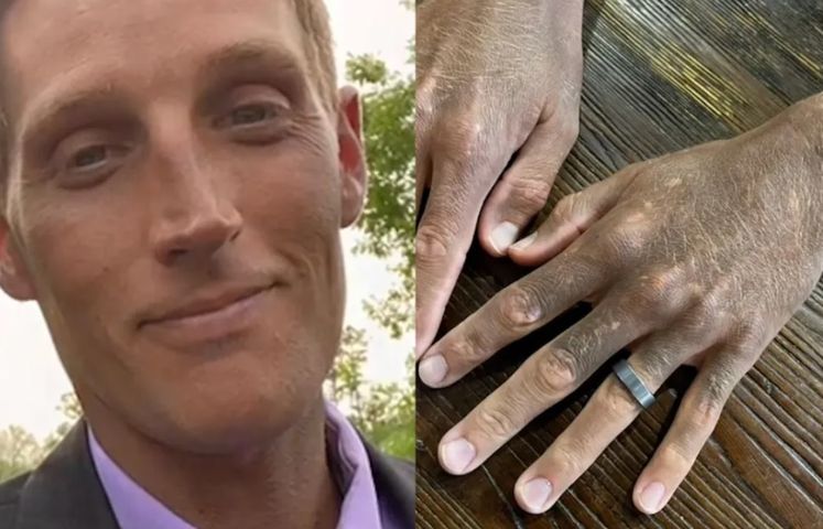 Skóra 34-latka zmieniła kolor. Mężczyzna przypuszcza, że to skutek uboczny terapii, ale lekarze nadal nie postawili diagnozy