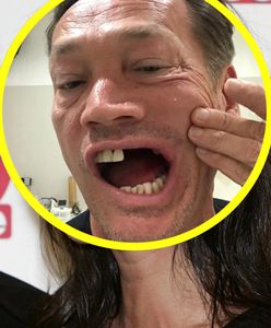 Wciąż wstydzi się pokazać twarz. Aktor miał straszliwy wypadek