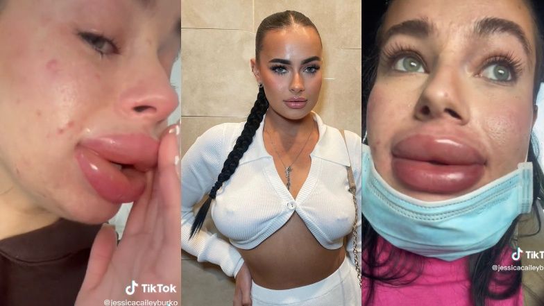 Infuencerka powiększyła usta w ramach współpracy. Po zabiegu omal nie EKSPLODOWAŁY: "Najgorszy dzień w moim życiu" (FOTO)