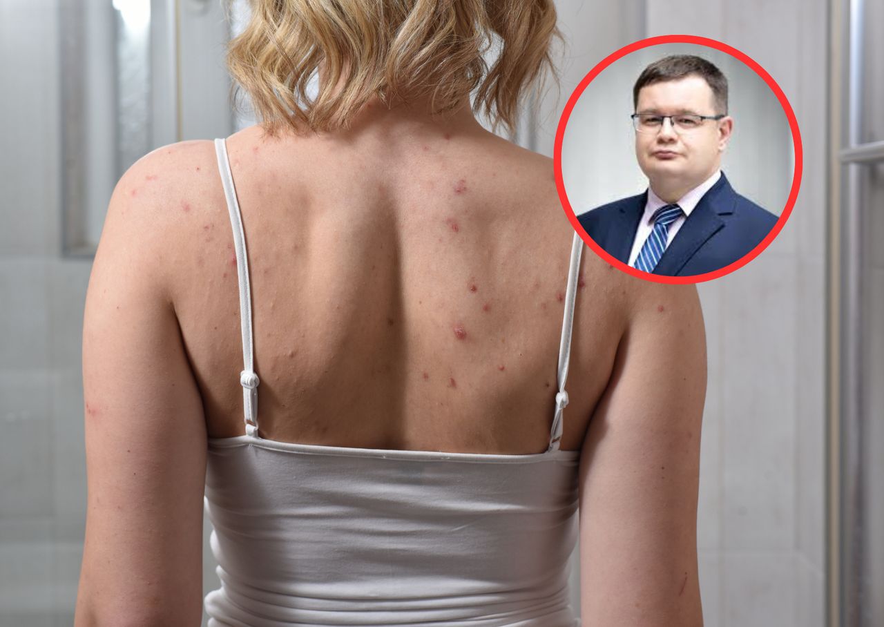 Domowe sposoby na leczenie kurzajek. Dermatolog przestrzega