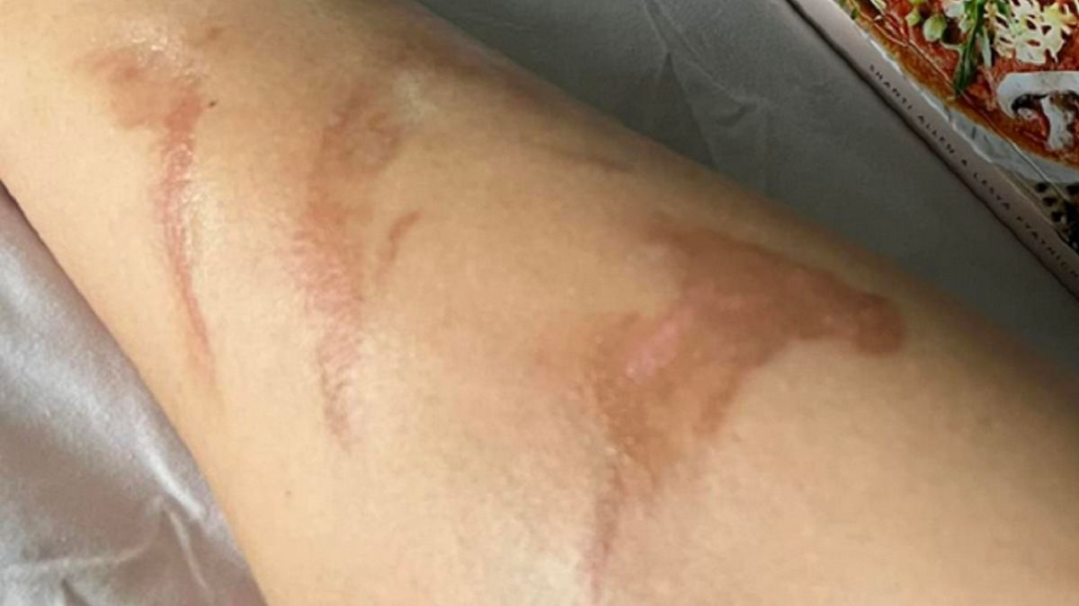 Australijka wróciła z tajemniczymi śladami na rękach.