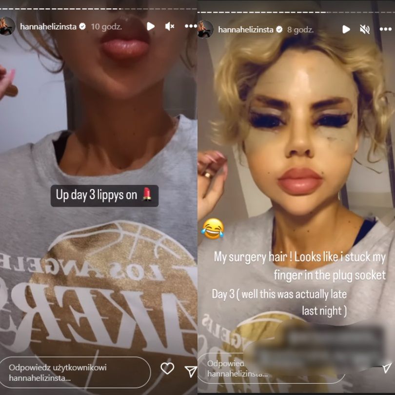 Uczestniczka brytyjskiego "Love Island" chwali się efektami operacji w tureckiej klinice