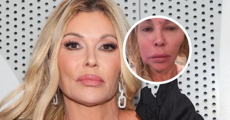 Była "żoną Beverly Hills". "Moja twarz jest gorsza niż kiedykolwiek"
