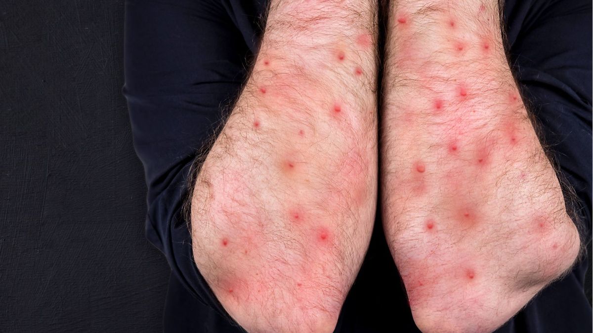 Alarmujące dane z Polski. Coraz więcej zachorowań na ospę, różyczkę i odrę.