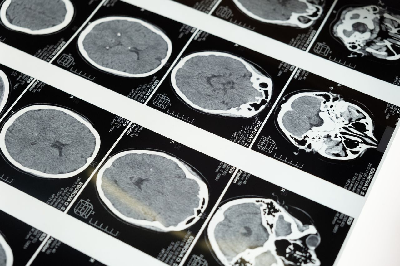 Nowe czujniki pozwolą wykryć chorobę Alzheimera bezobjawowo