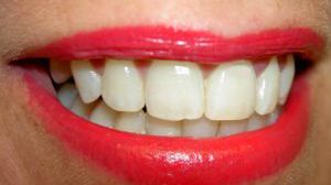 Znikające nici dentystyczne 1