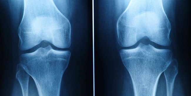 Mężczyźni dwukrotnie bardziej narażeni na zgon z powodu osteoporozy