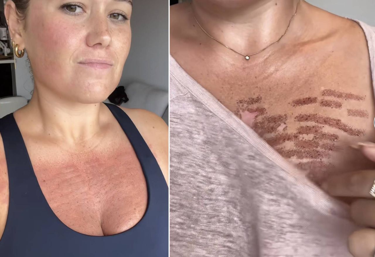 Woman suffers first-degree burns after laser treatment at beauty clinic, shares ordeal on TikTok