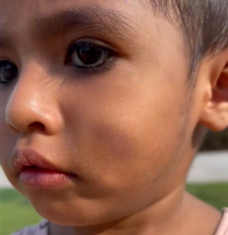 Dziewczynka ma liczne ślady na ciele