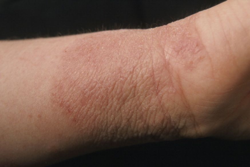 Alergia kontaktowa – przyczyny, objawy, leczenie i profilaktyka