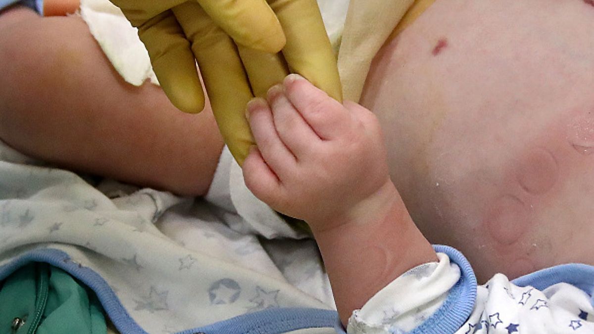 Choroba dzieci może mieć związek z pojawieniem się koronawirusa