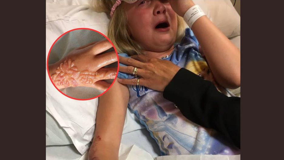 Niebezpieczna letnia "pamiątka". "Moja córeczka może mieć blizny do końca życia"