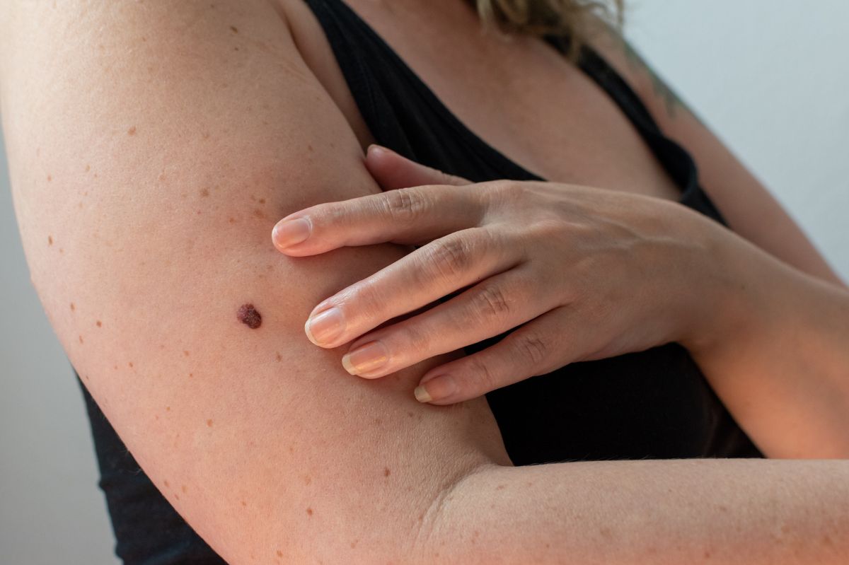 Protect your skin: Essential steps to guard moles from melanoma