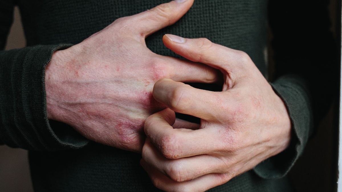 Świerzb to zakaźna choroba dermatologiczna, którą wywołuje świerzbowiec ludzki.