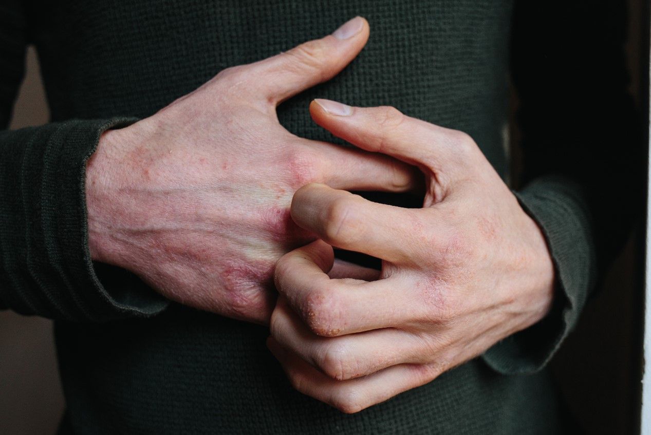 Świerzb - charakterystyka, objawy, leczenie, domowe sposoby, jak można się zarazić