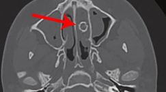 Ciało obce w nosie nastolatka. Rentgen ujawnił coś zaskakującego