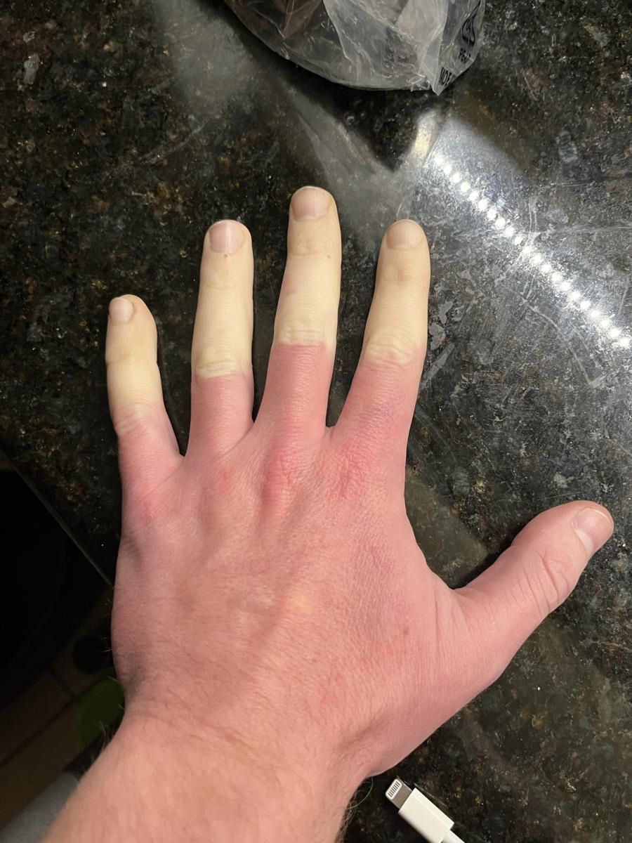 Objaw Raynauda może świadczyć o poważnych chorobach