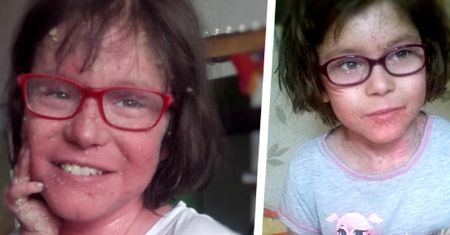 Dotyk matki powoduje piekielny ból, rany i pęcherze. Julia potrzebuje rehabilitacji i produktów do pielęgnacji ciała