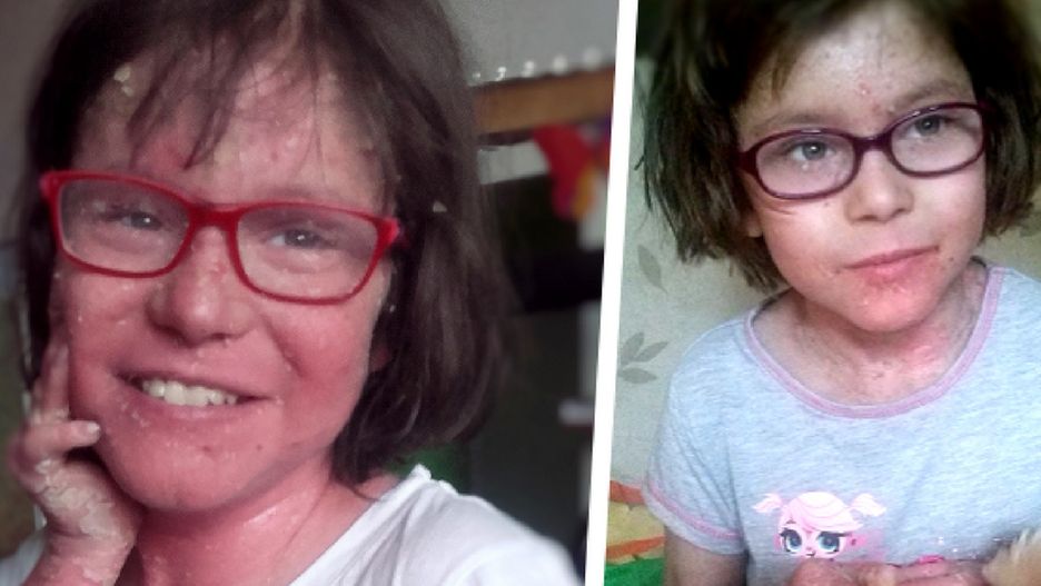 Julka od urodzenia zmaga się z pęcherzowym oddzielaniem się naskórka