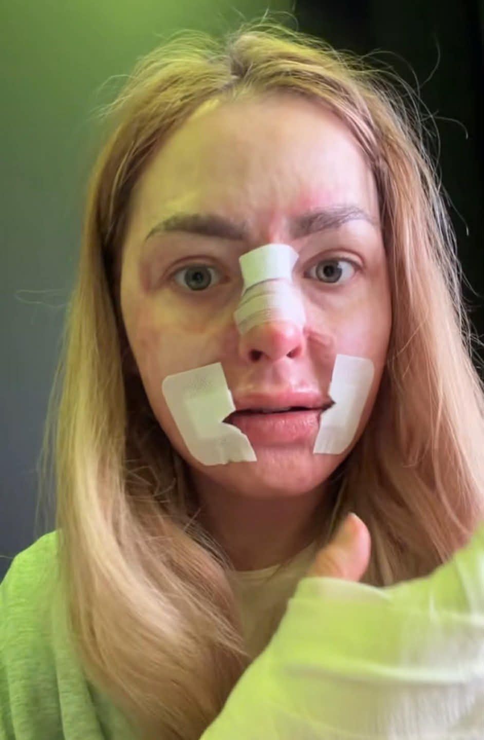 Tiktokerka, która płonęła żywcem, przeszła kolejną operację