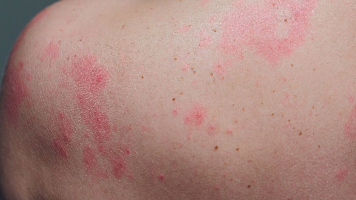 Pokrzywka w medycynie to niejednolity zespół chorobowy, którego częścią wspólną jest podstawowy objaw skórny – bąble pokrzywkowe. 