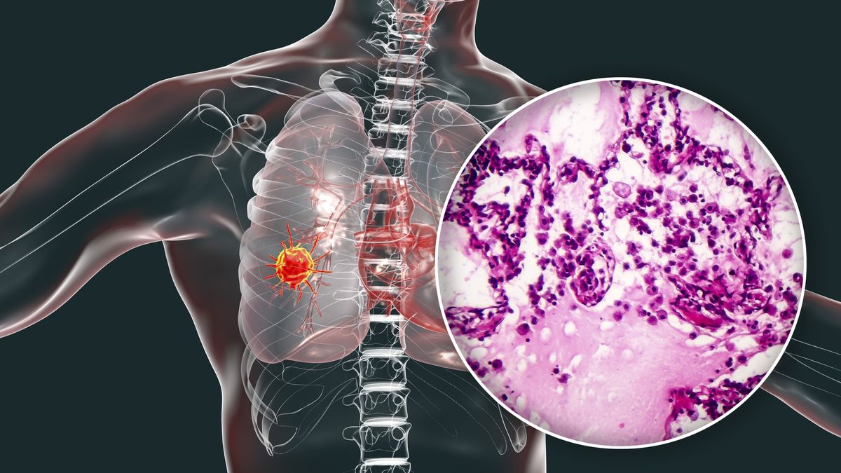 Glukoza to paliwo dla komórek nowotworowych