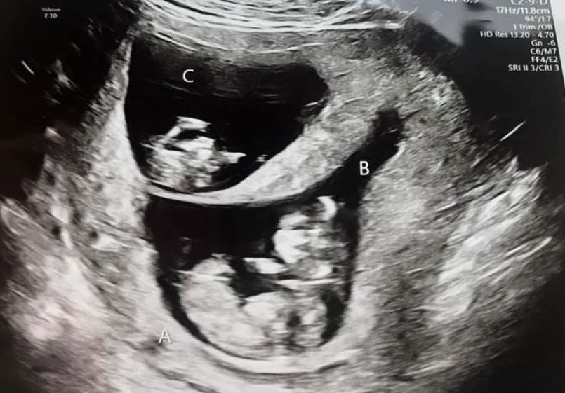 Okazało się, że Kaylie jest w ciąży z trojaczkami